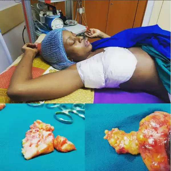 Big Brother’s Makosi Musambasi shows off lump removed from her breast